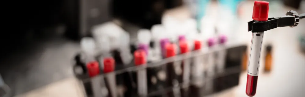 Close-up of a blood sample in a test tube with a red cap held by a clamp, with a blurred background of additional test tubes.